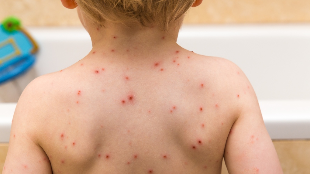 Chickenpox party at centre of B.C. small claims dispute [Video]