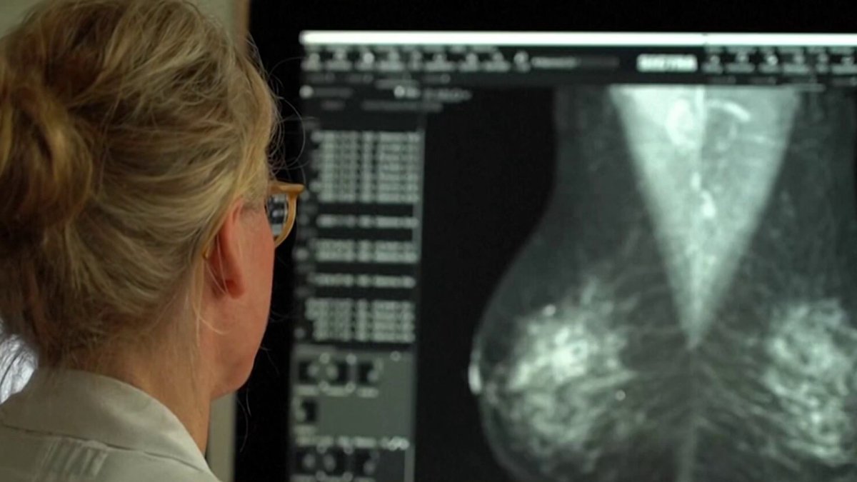 How CT paved the way for a national dense breast tissue policy  NBC Connecticut [Video]