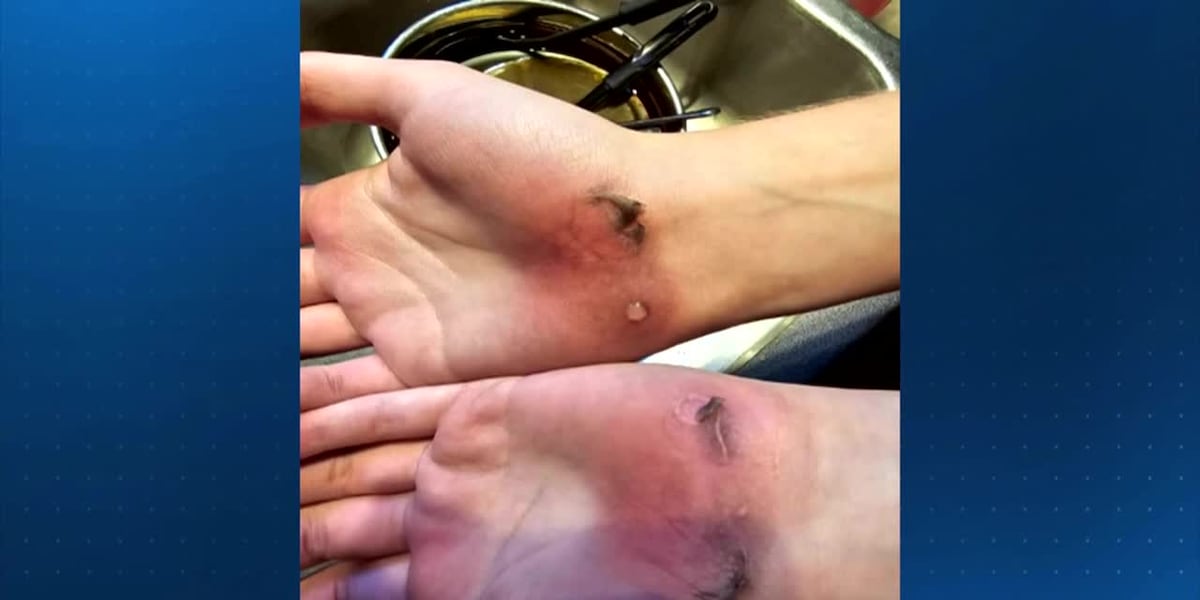 Father outraged when volleyball practice leaves daughter with blistered hands [Video]