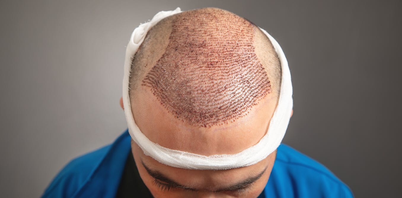 As hair transplants become big business, heres what you need to know about the risks [Video]