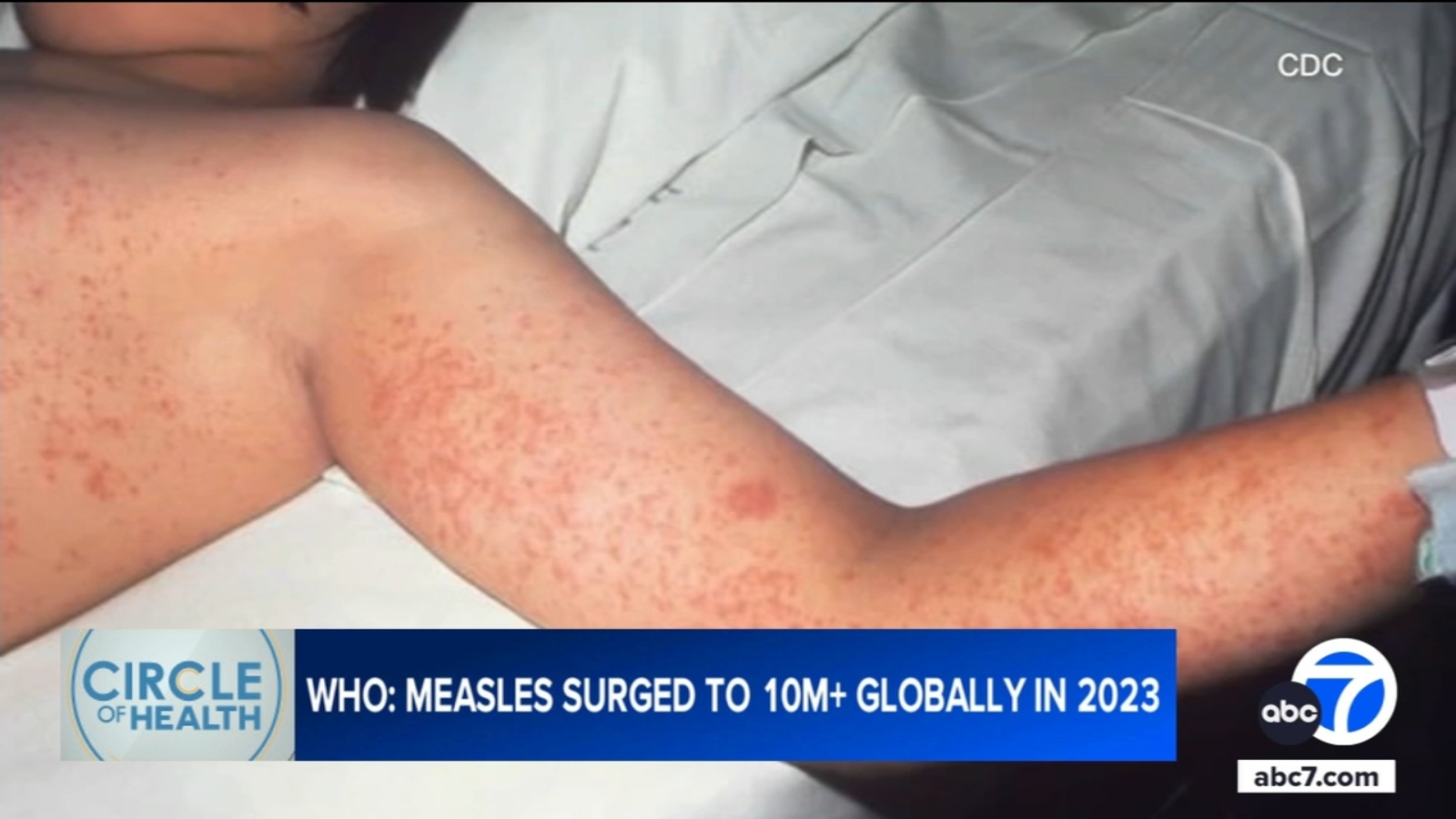 With measles cases surging globally, health officials tell us what LA County is doing right – including the importance of vaccine [Video]